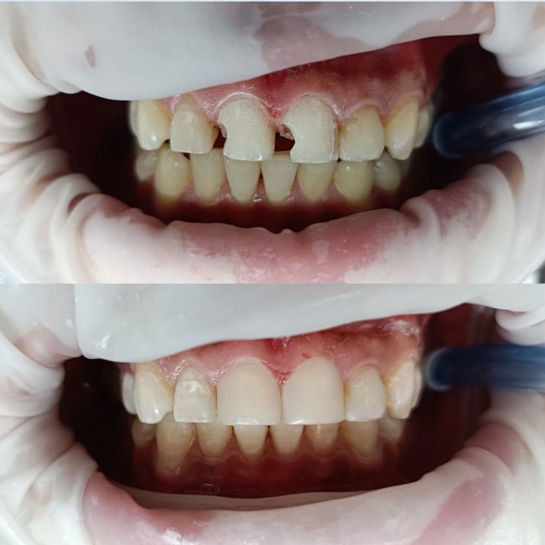 Rehabilitacion oral